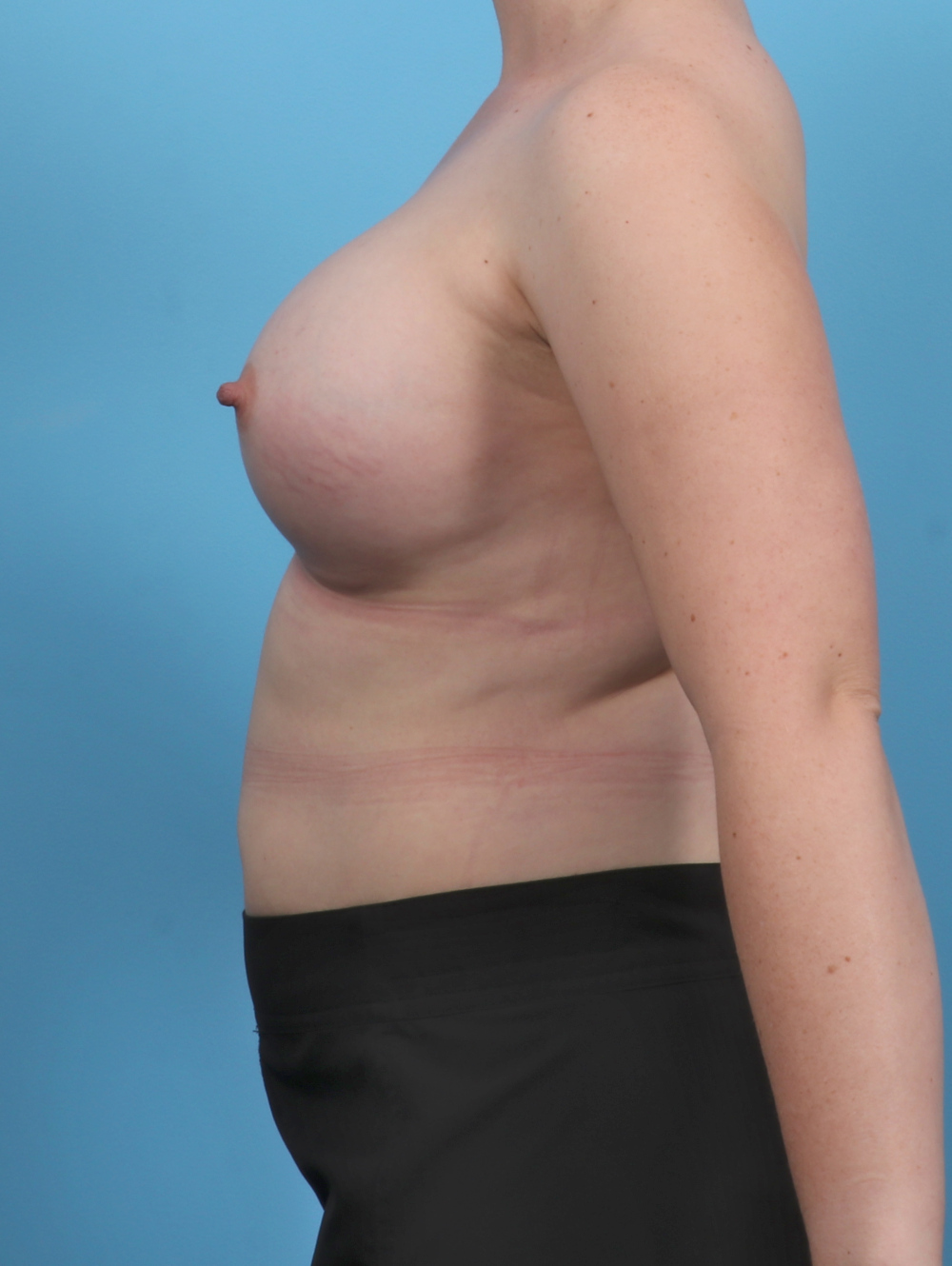 Breast Augmentation Patient Photo - Case 5506 - after view-2