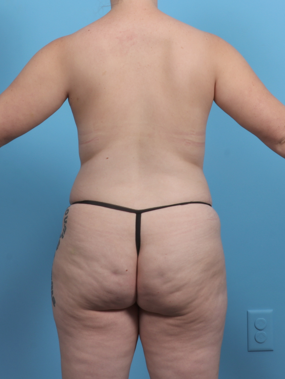 Liposuction Patient Photo - Case 5514 - before view-1