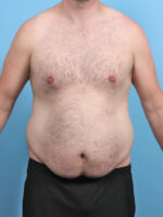 Liposuction - Case 5542 - Before