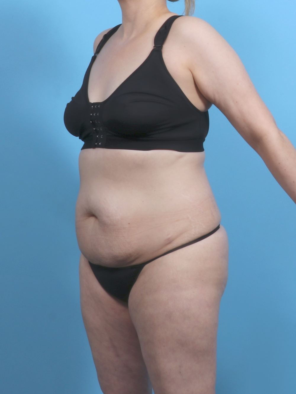 Tummy Tuck Patient Photo - Case 5552 - before view-1