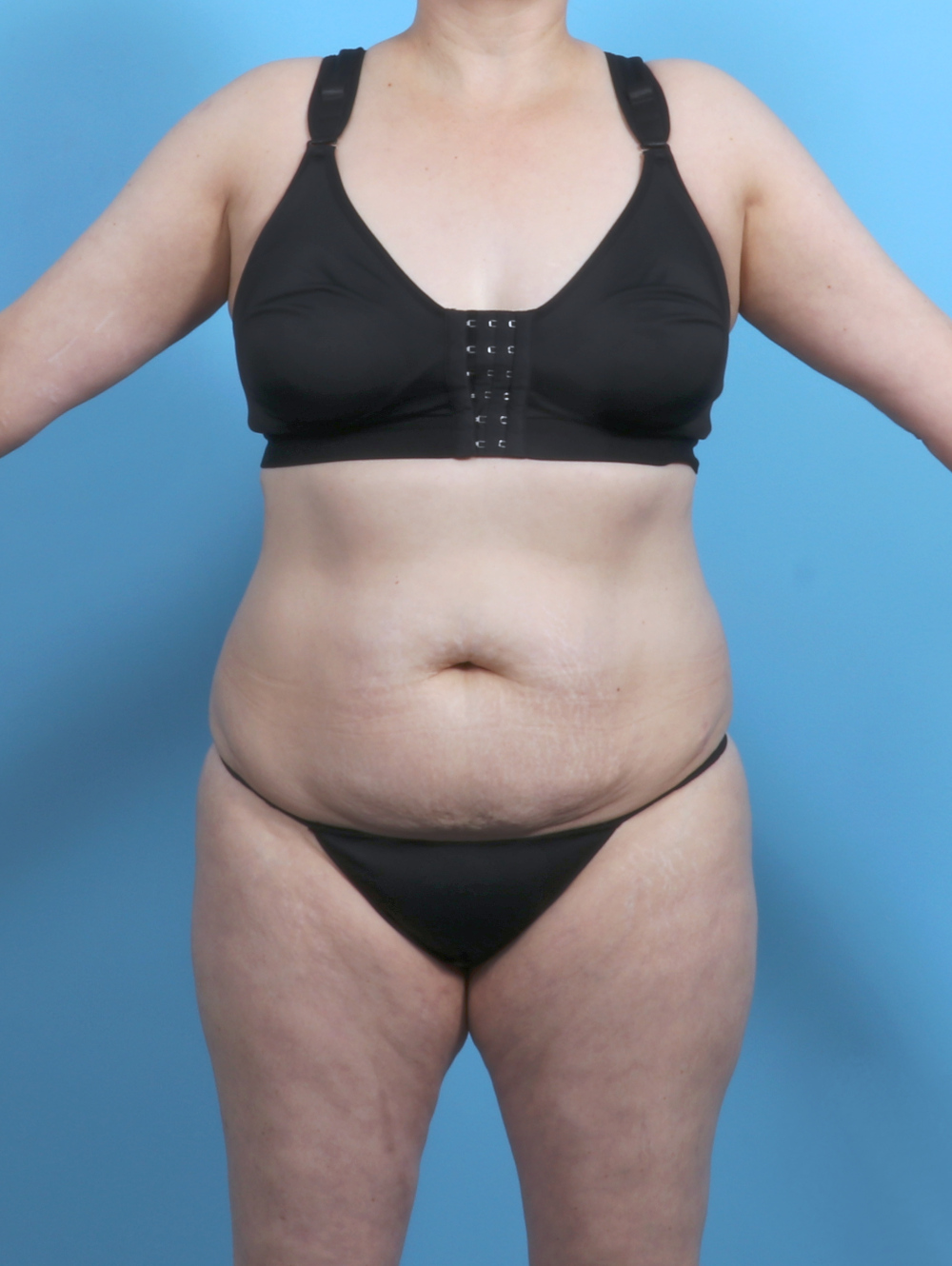 Tummy Tuck Patient Photo - Case 5552 - before view-