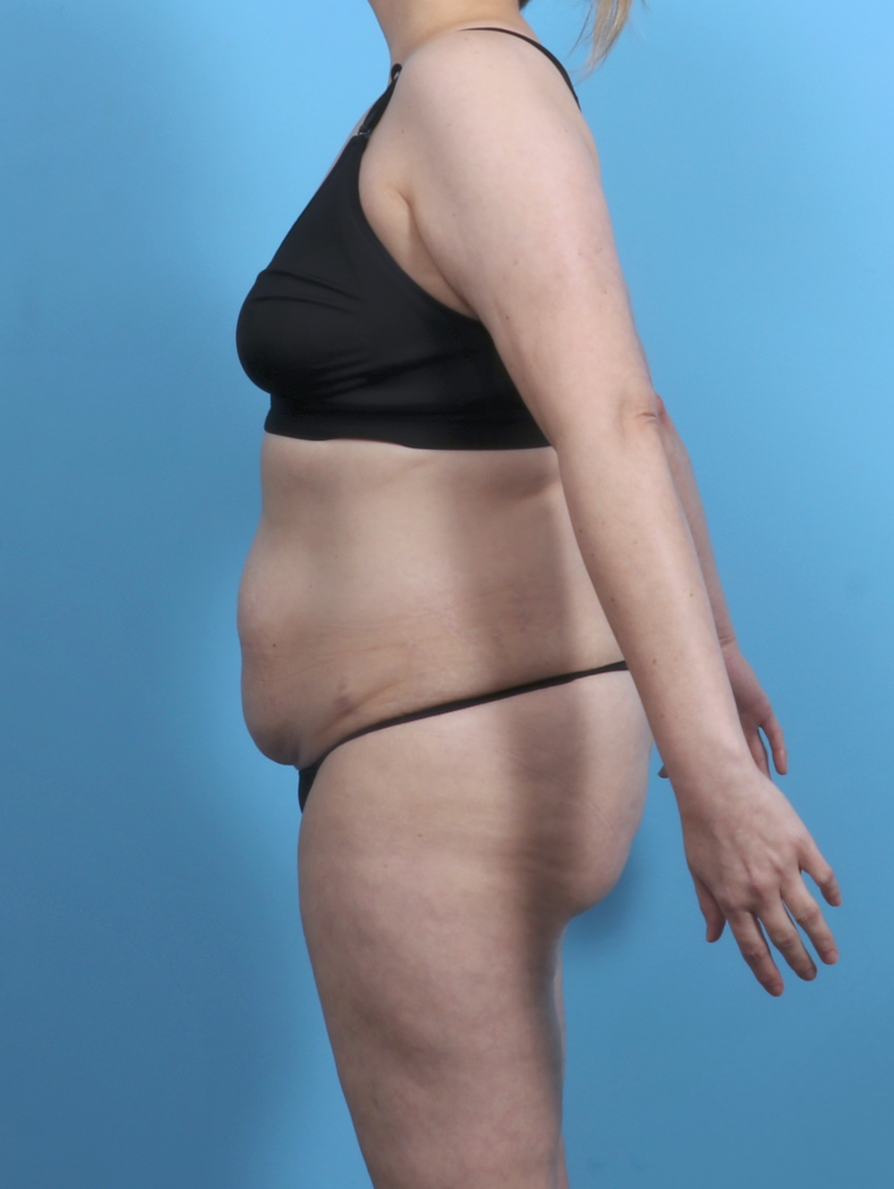 Tummy Tuck Patient Photo - Case 5552 - before view-2