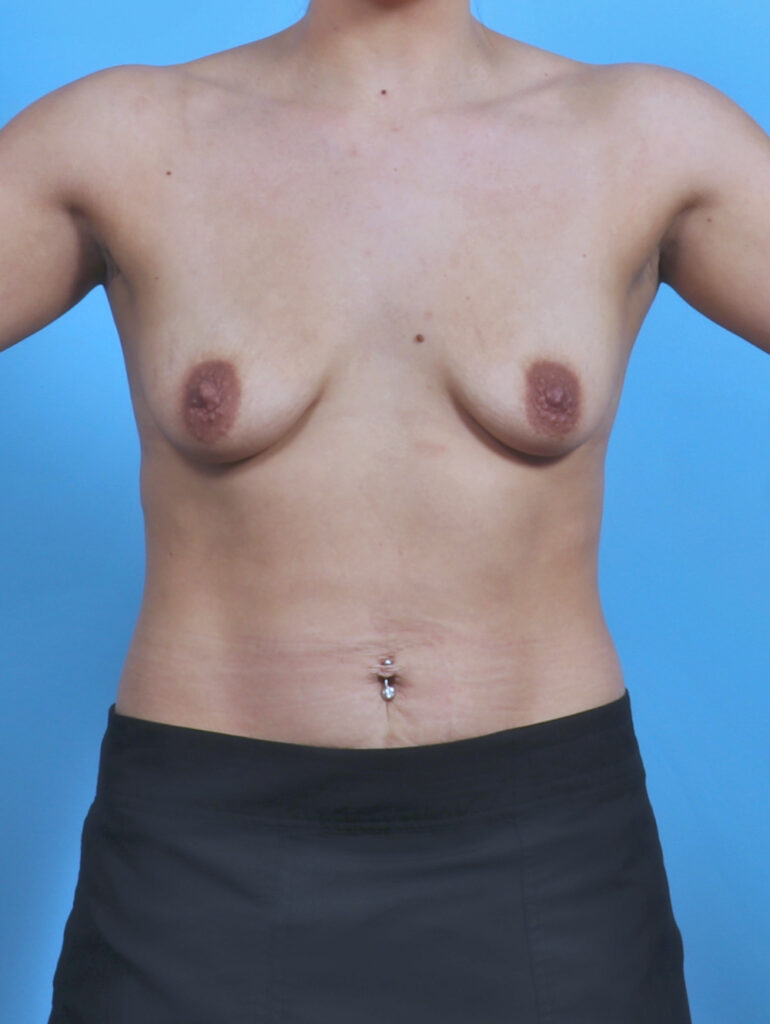 Breast Lift with Implants - Case 5560 - Before