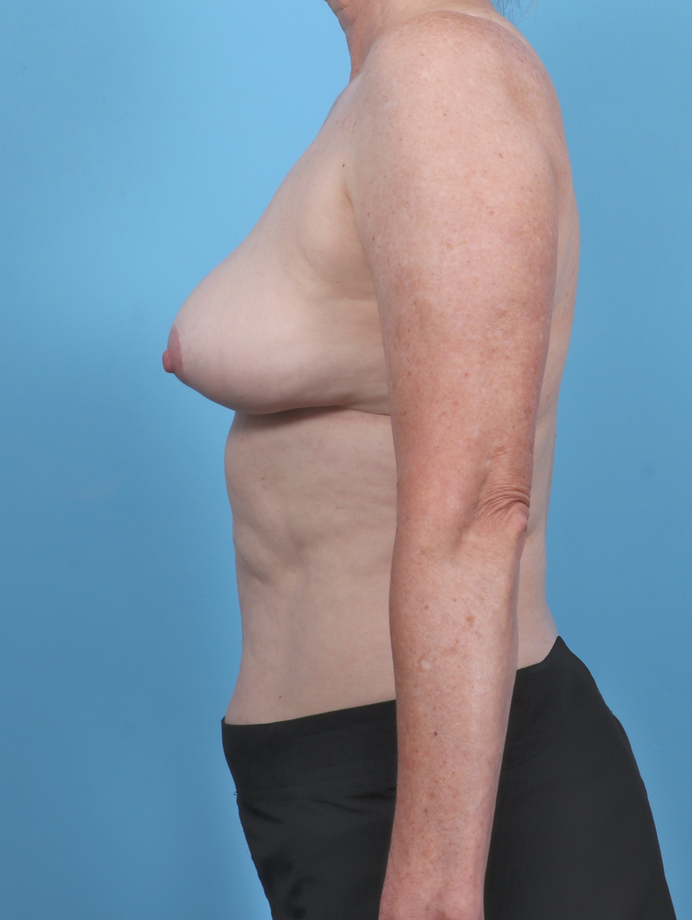 Breast Implant Revision Patient Photo - Case 5568 - after view-2