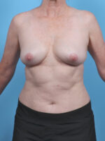 Breast Implant Revision - Case 5568 - After