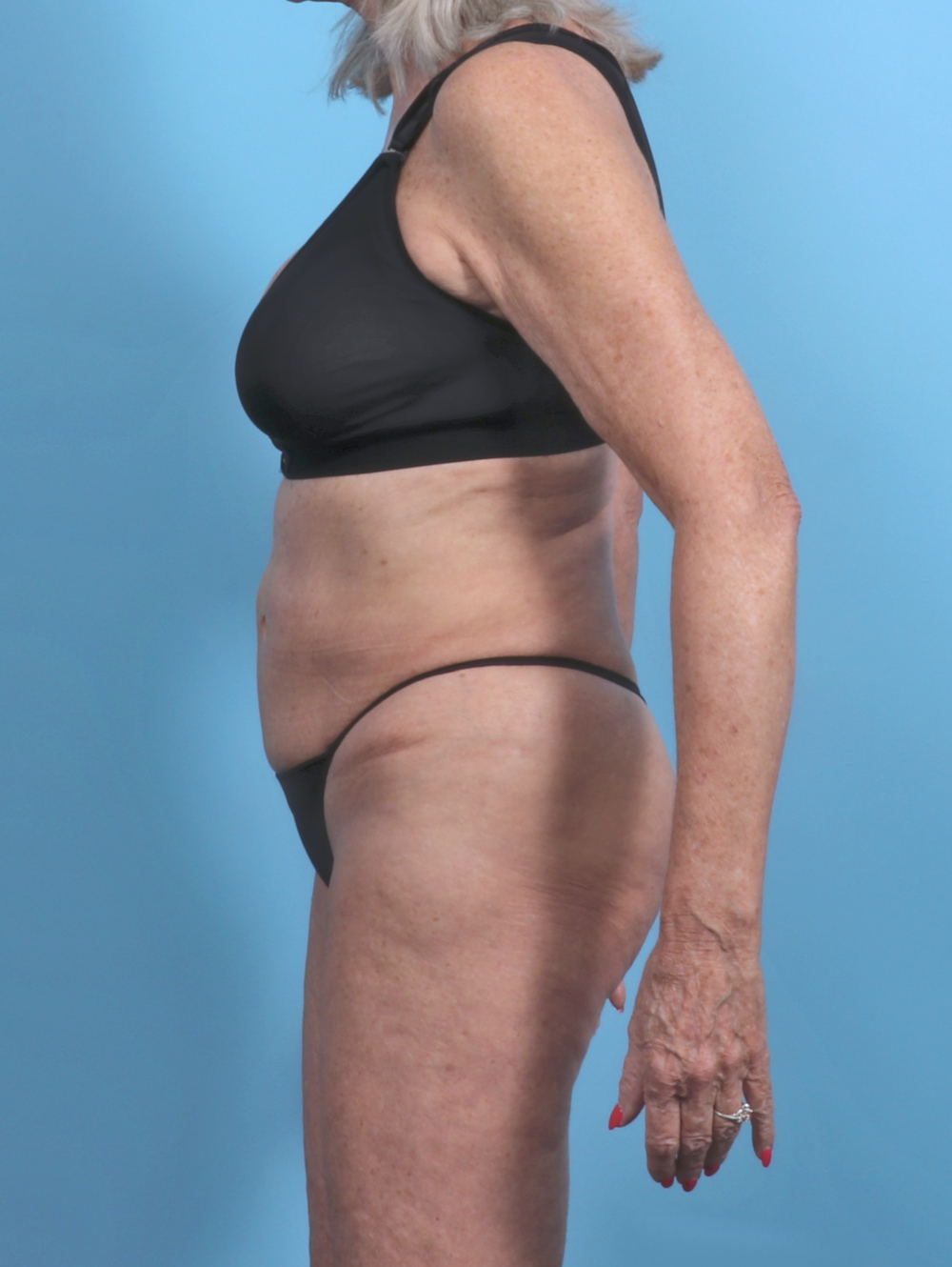 Tummy Tuck Patient Photo - Case 5576 - before view-2