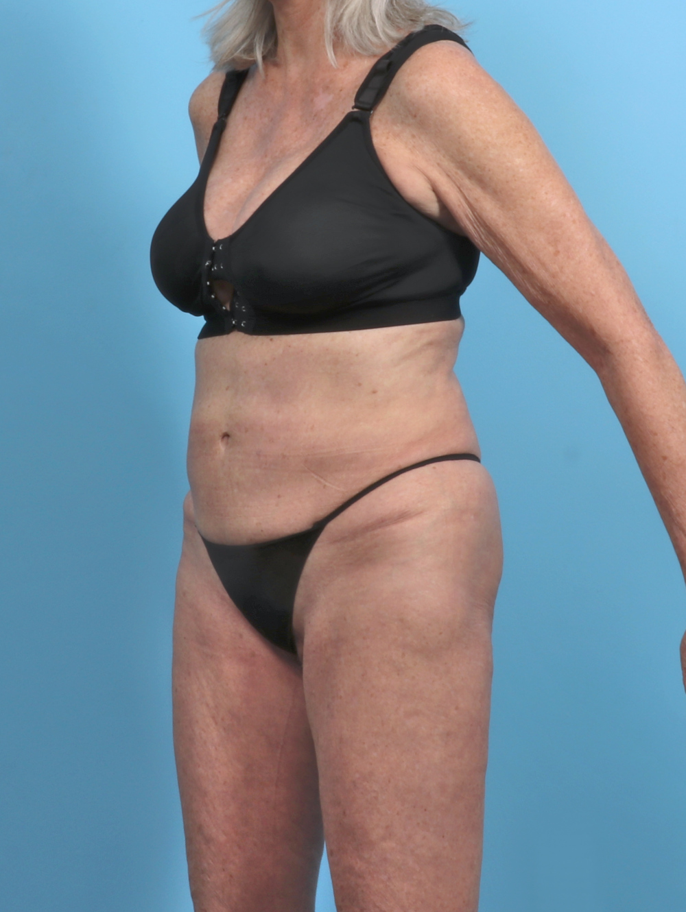 Tummy Tuck Patient Photo - Case 5576 - before view-1