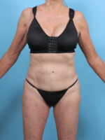 Tummy Tuck - Case 5576 - After