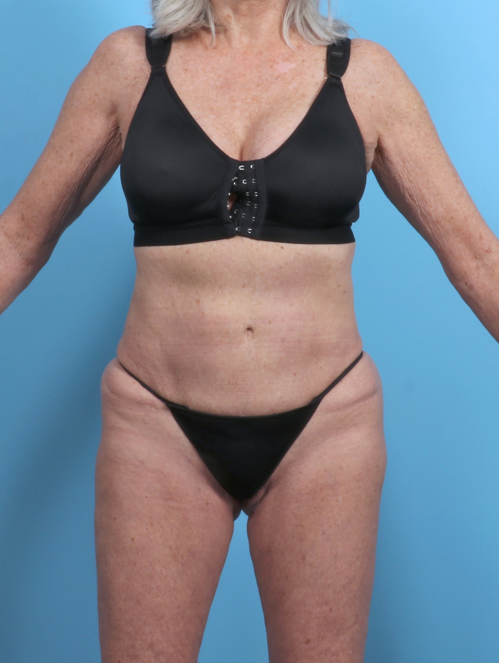 Tummy Tuck Patient Photo - Case 5576 - before view-
