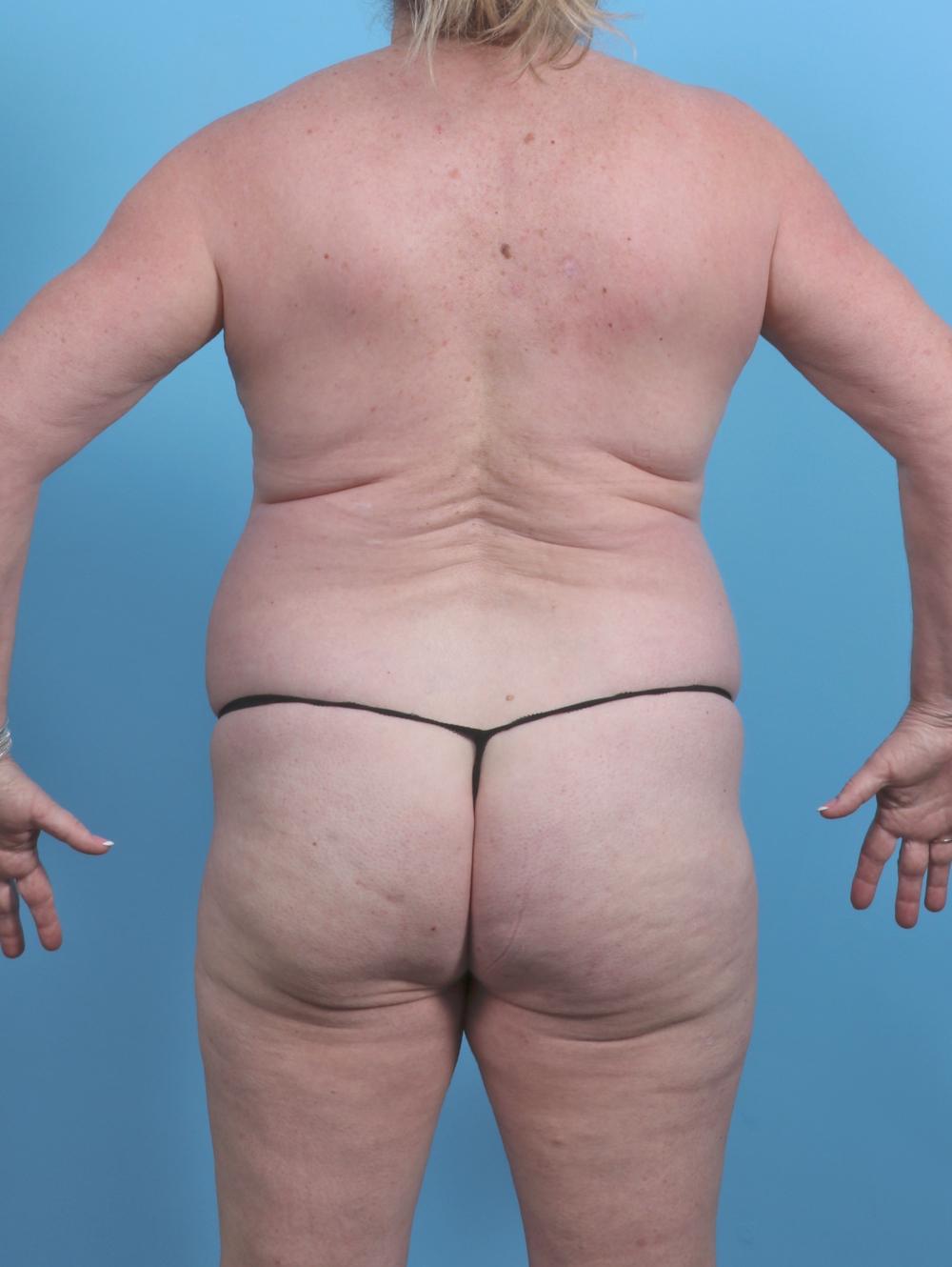Liposuction Patient Photo - Case 5592 - before view-1