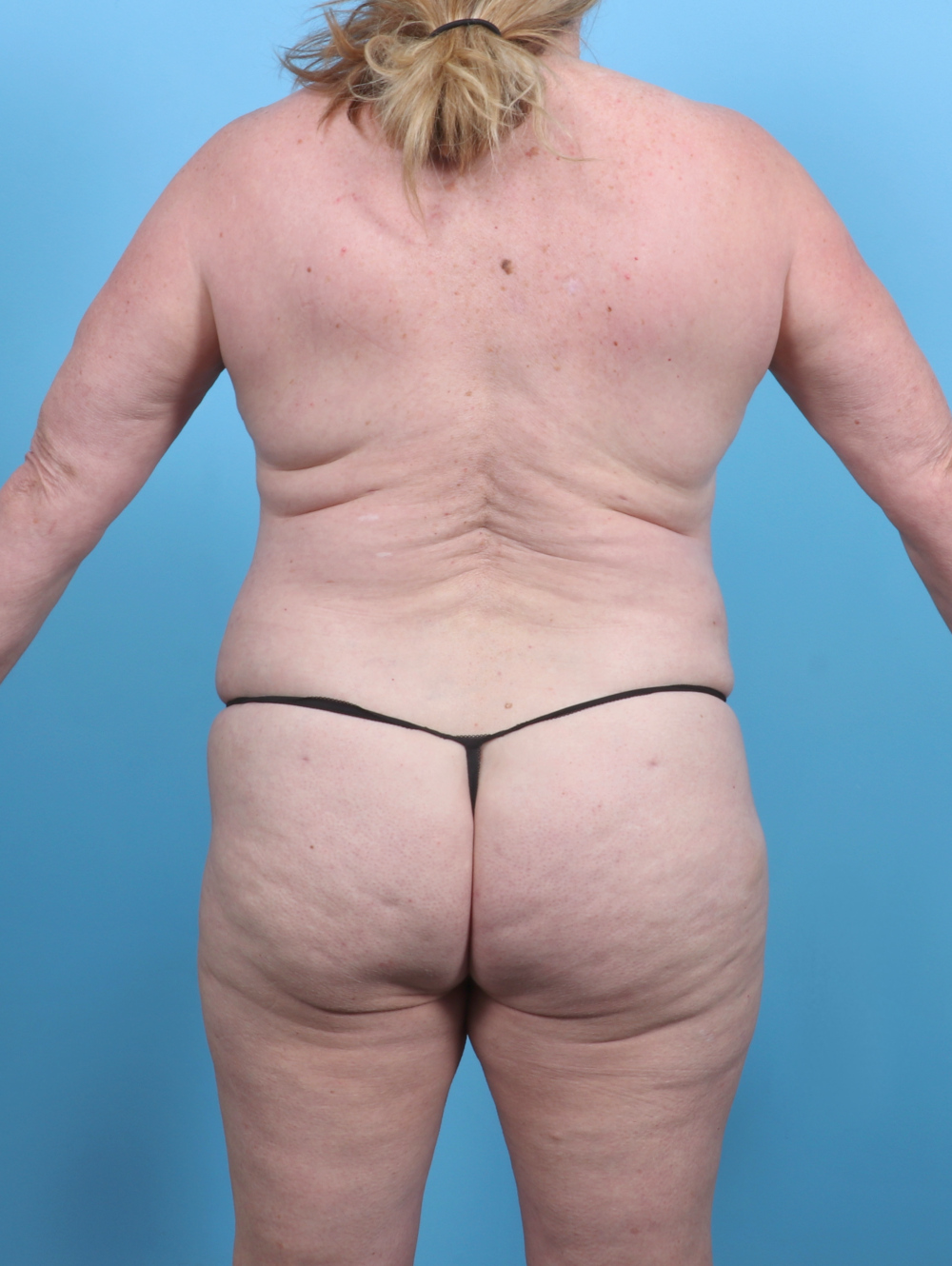Liposuction Patient Photo - Case 5592 - after view-1