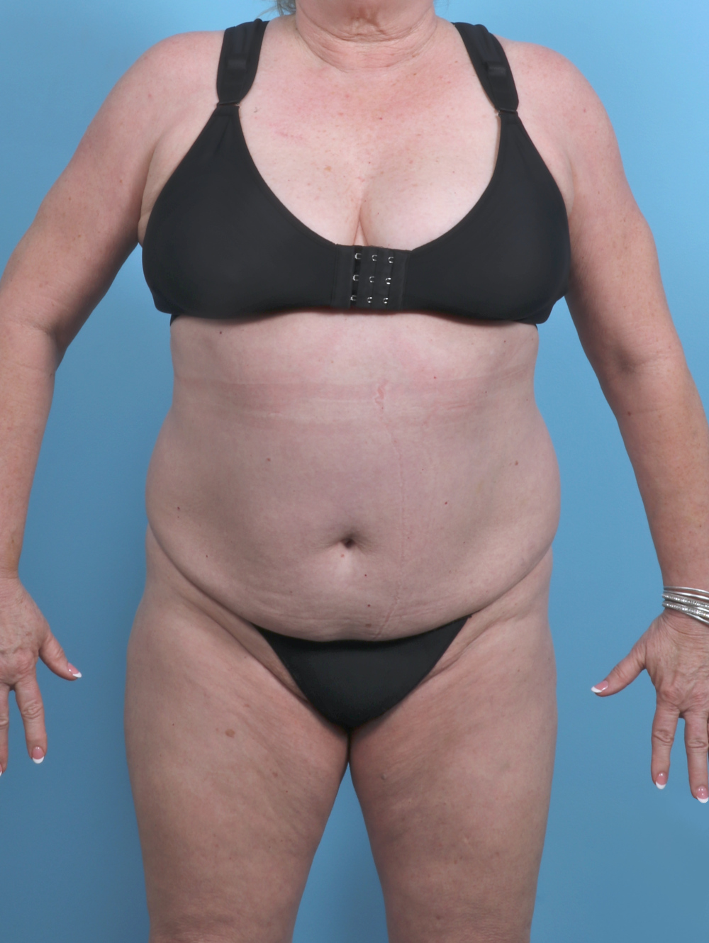 Liposuction Patient Photo - Case 5592 - before view-0