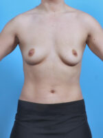 Breast Augmentation - Case 5618 - Before