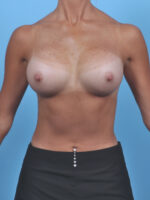 Breast Augmentation - Case 5626 - After