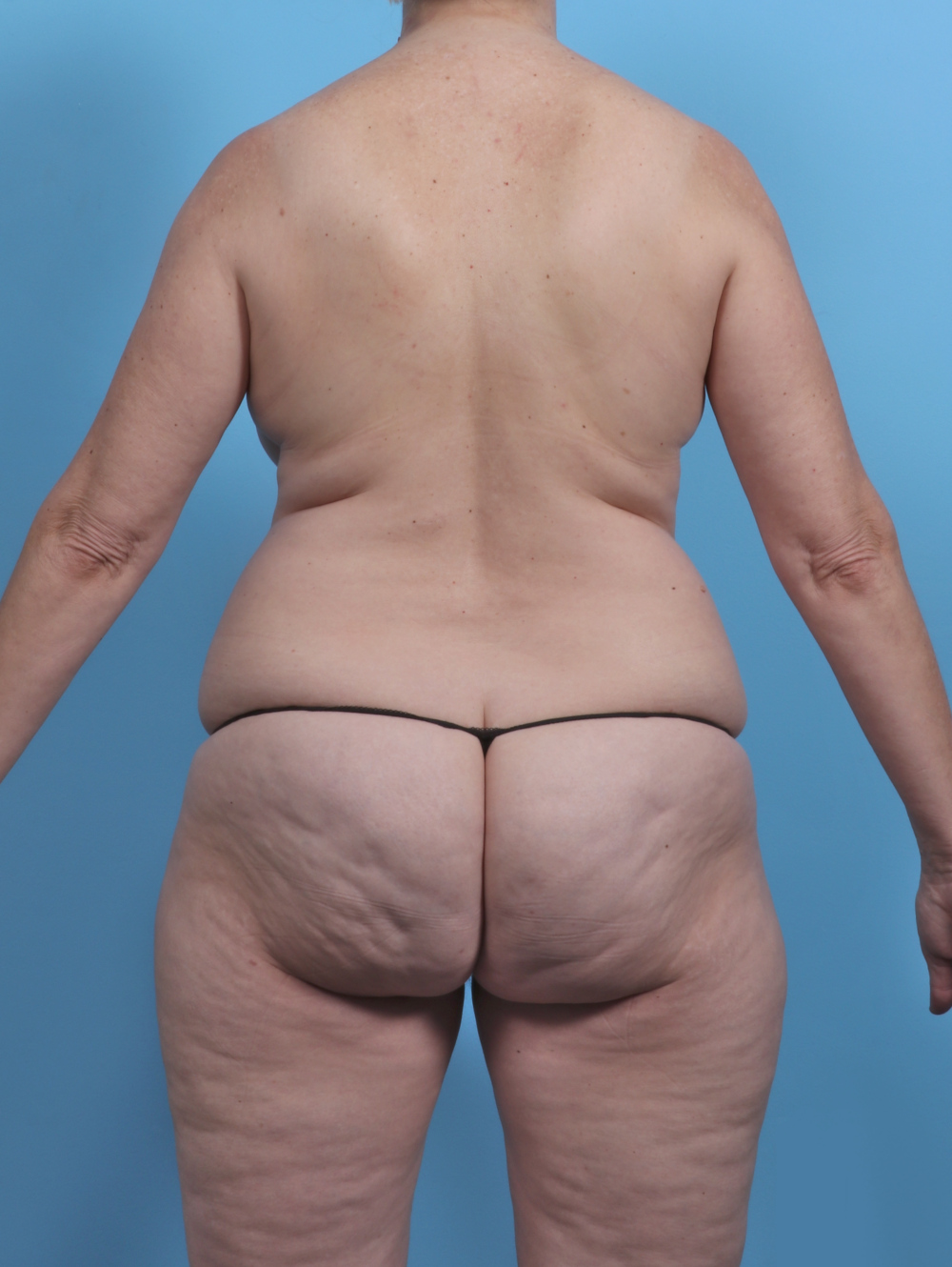 Liposuction Patient Photo - Case 5634 - before view-1