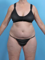 Liposuction - Case 5634 - Before