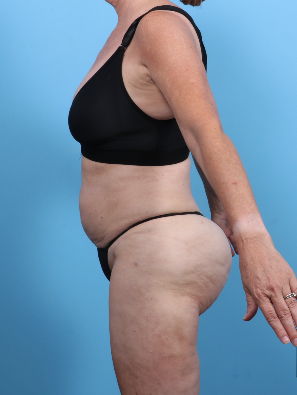 Liposuction Patient Photo - Case 5634 - after view-3