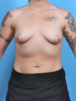 Breast Lift with Implants - Case 5652 - Before