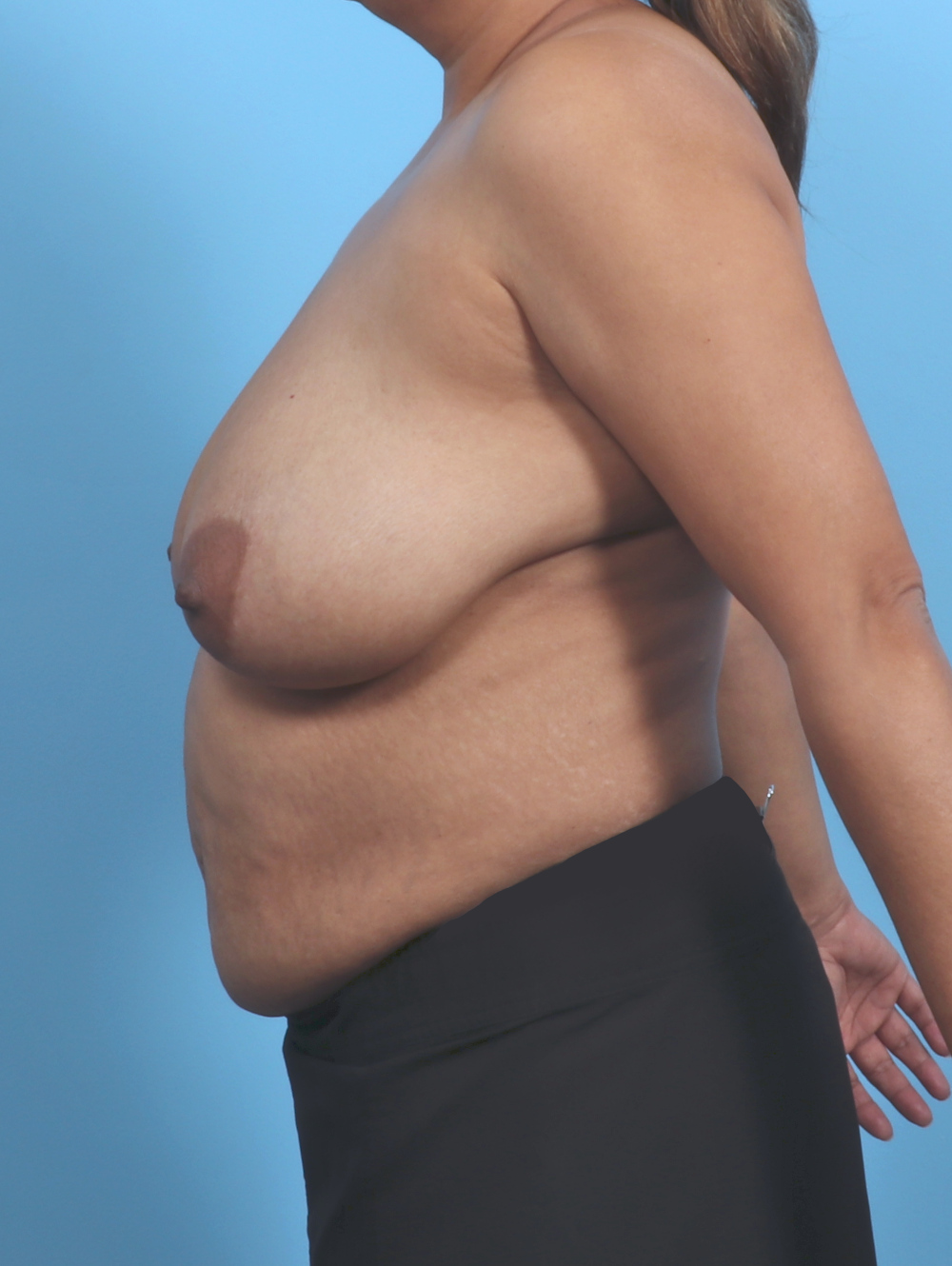 Breast Lift/Reduction Patient Photo - Case 5660 - before view-2
