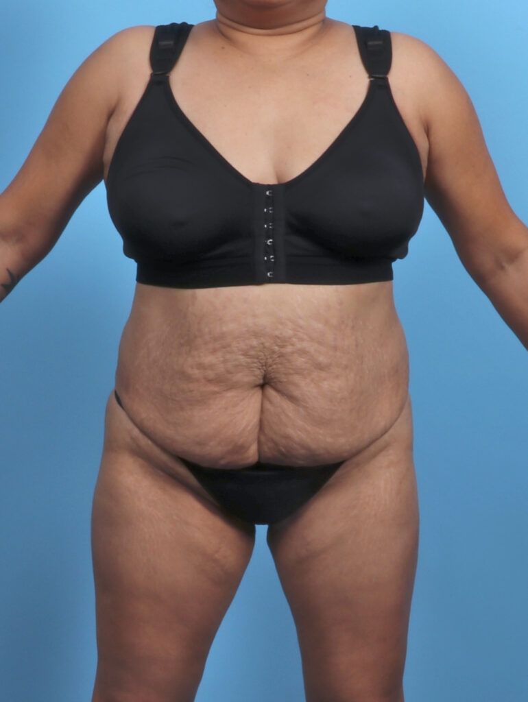 Liposuction - Case 5676 - Before