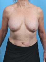 Breast Implant Revision - Case 5686 - Before