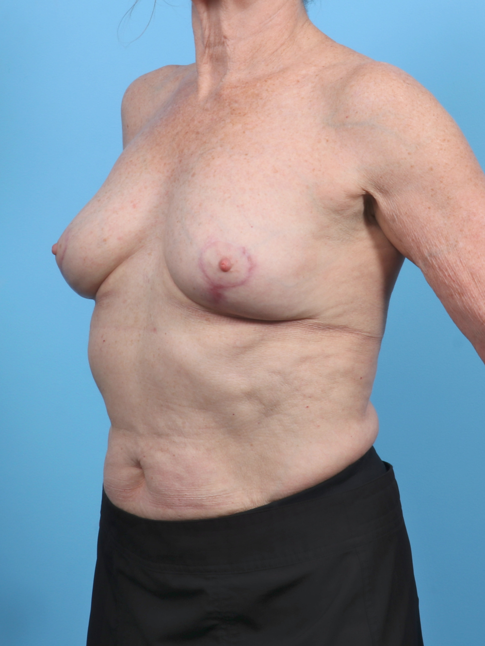 Breast Implant Revision Patient Photo - Case 5686 - after view-1