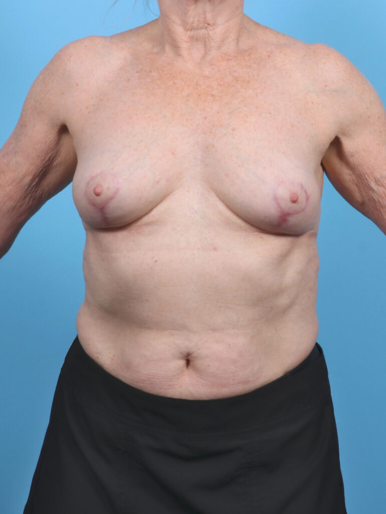 Breast Implant Revision - Case 5686 - After