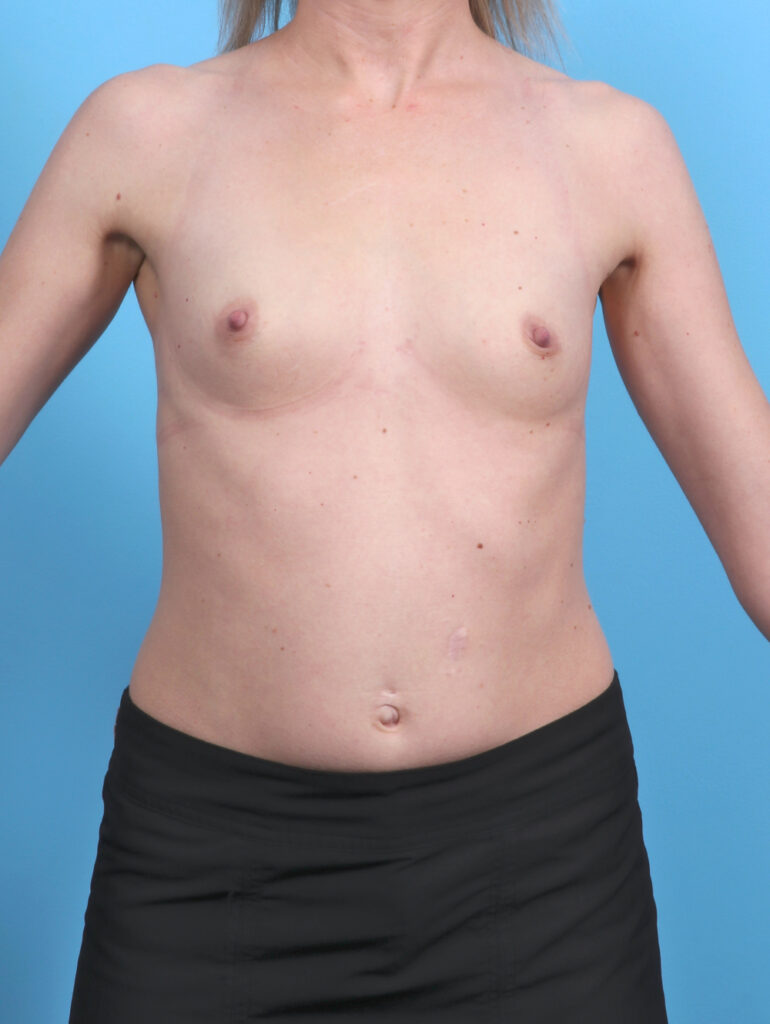 Breast Augmentation - Case 5747 - Before