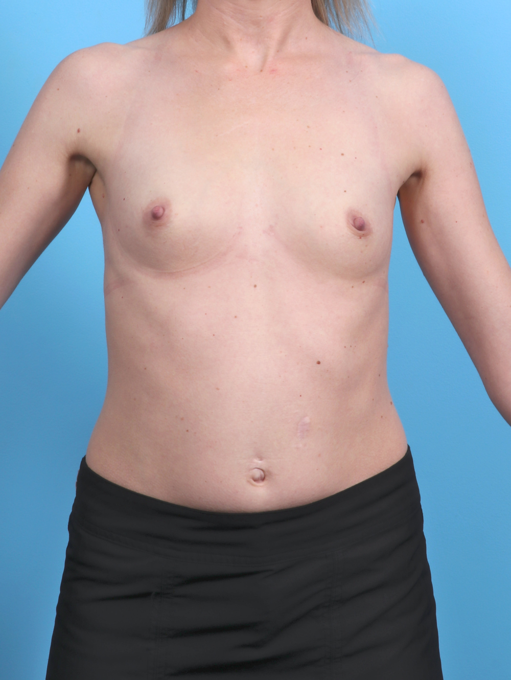 Breast Augmentation Patient Photo - Case 5747 - before view-
