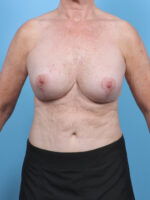 Breast Implant Revision - Case 5755 - After