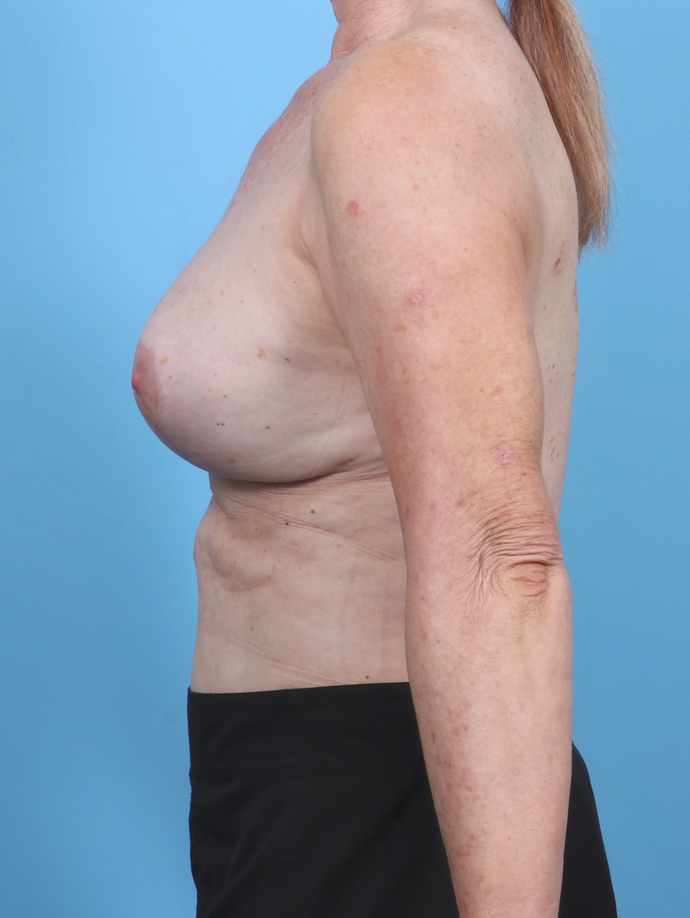 Breast Implant Revision Patient Photo - Case 5755 - after view-2