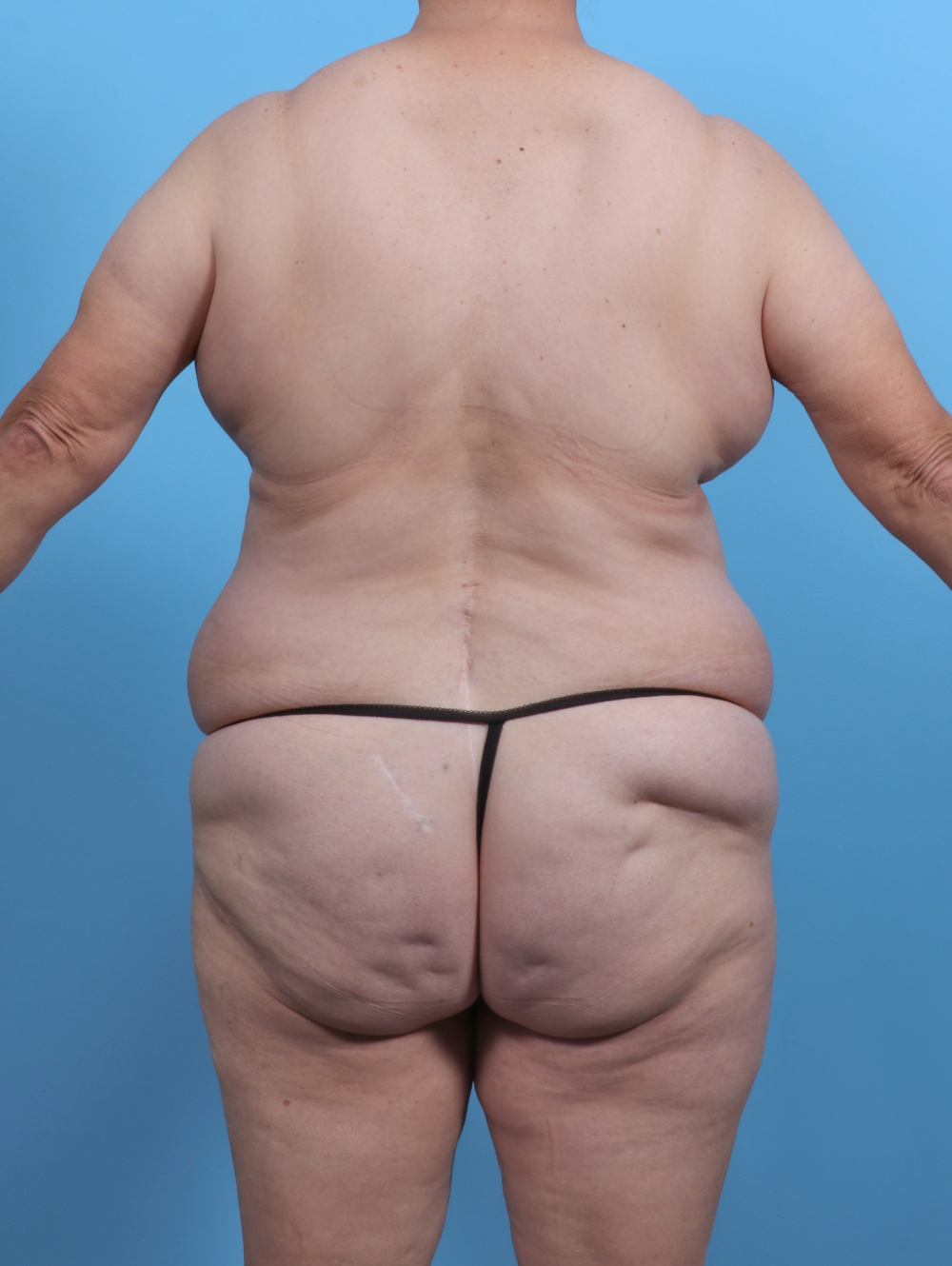 Liposuction Patient Photo - Case 5763 - before view-3