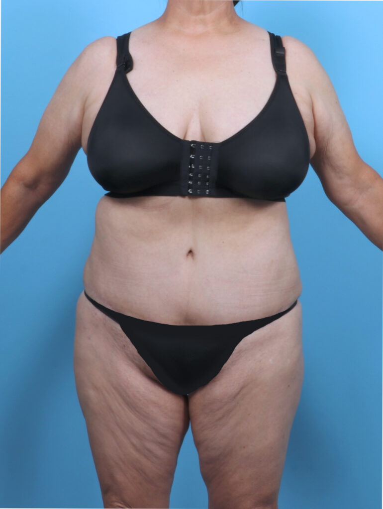 Liposuction - Case 5763 - After