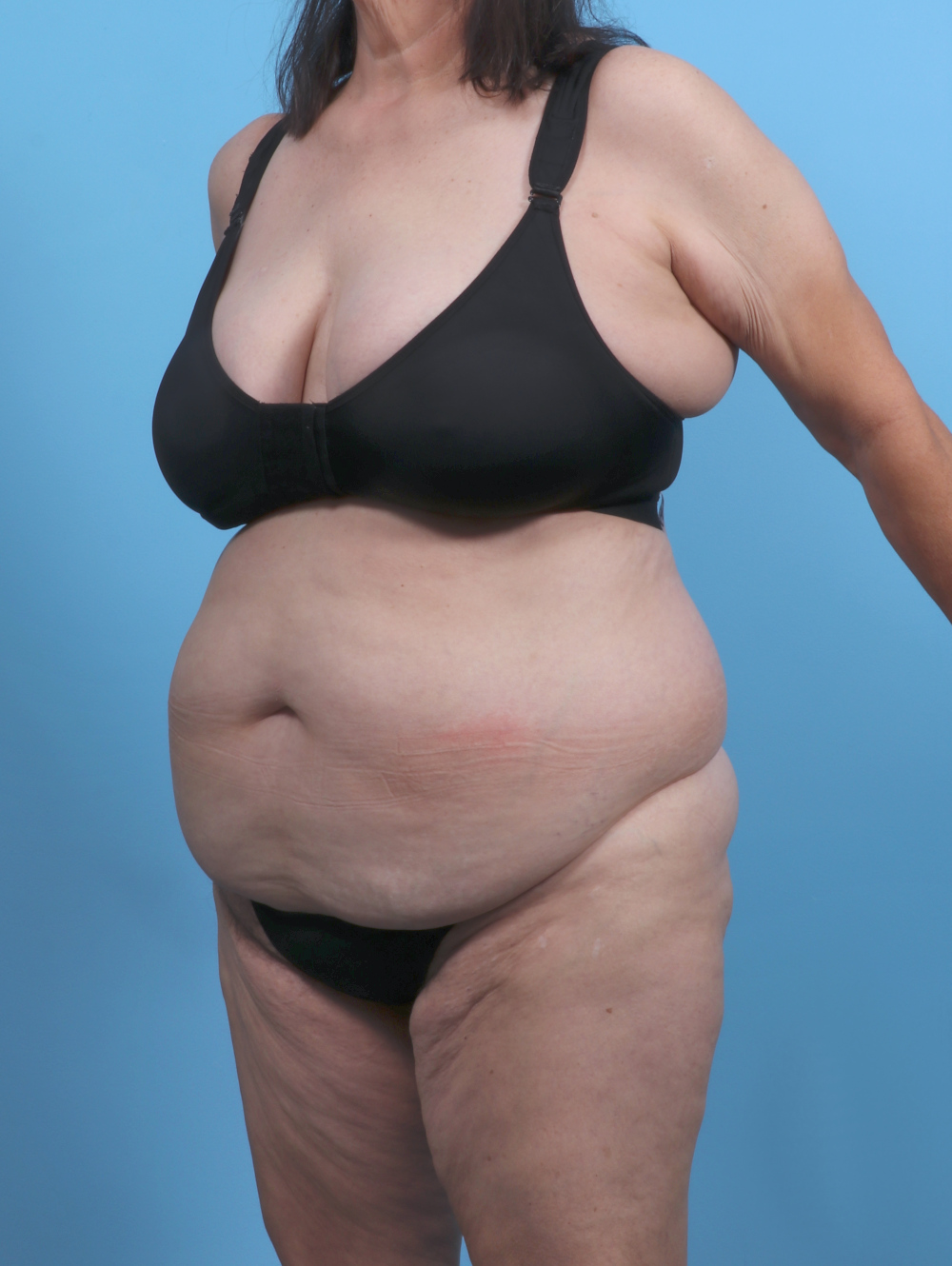 Liposuction Patient Photo - Case 5763 - before view-1