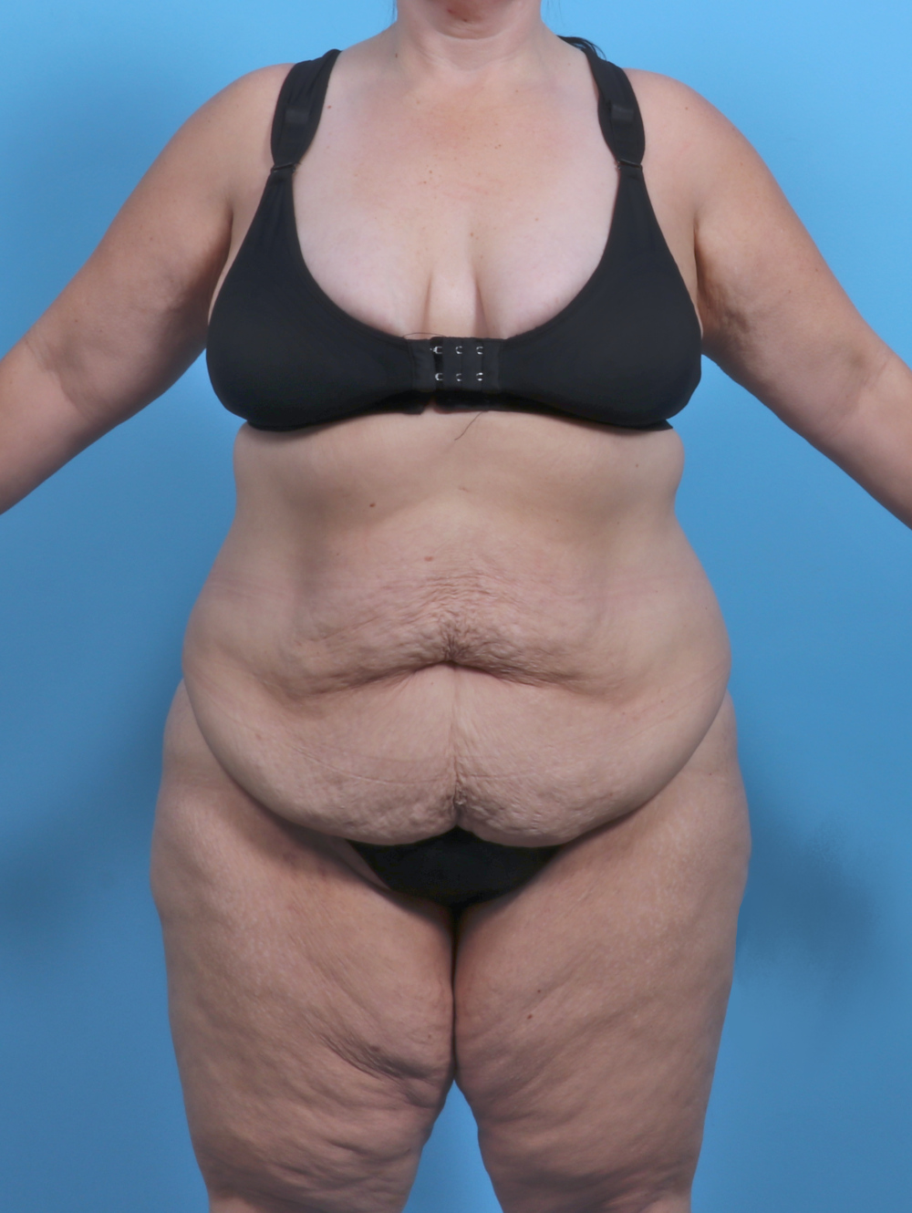Tummy Tuck Patient Photo - Case 5789 - before view-0