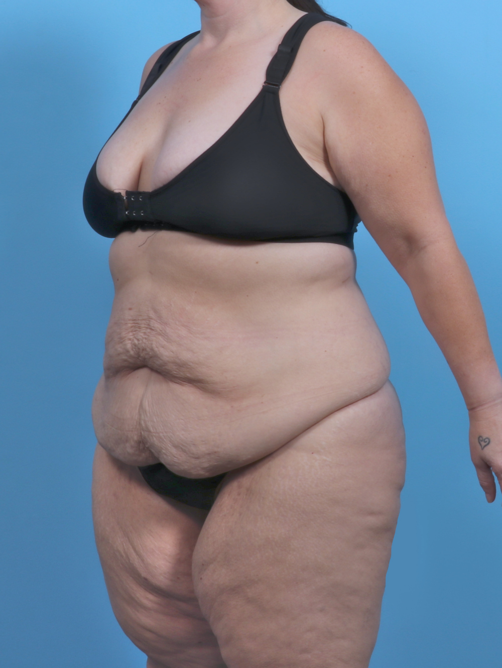 Tummy Tuck Patient Photo - Case 5789 - before view-1