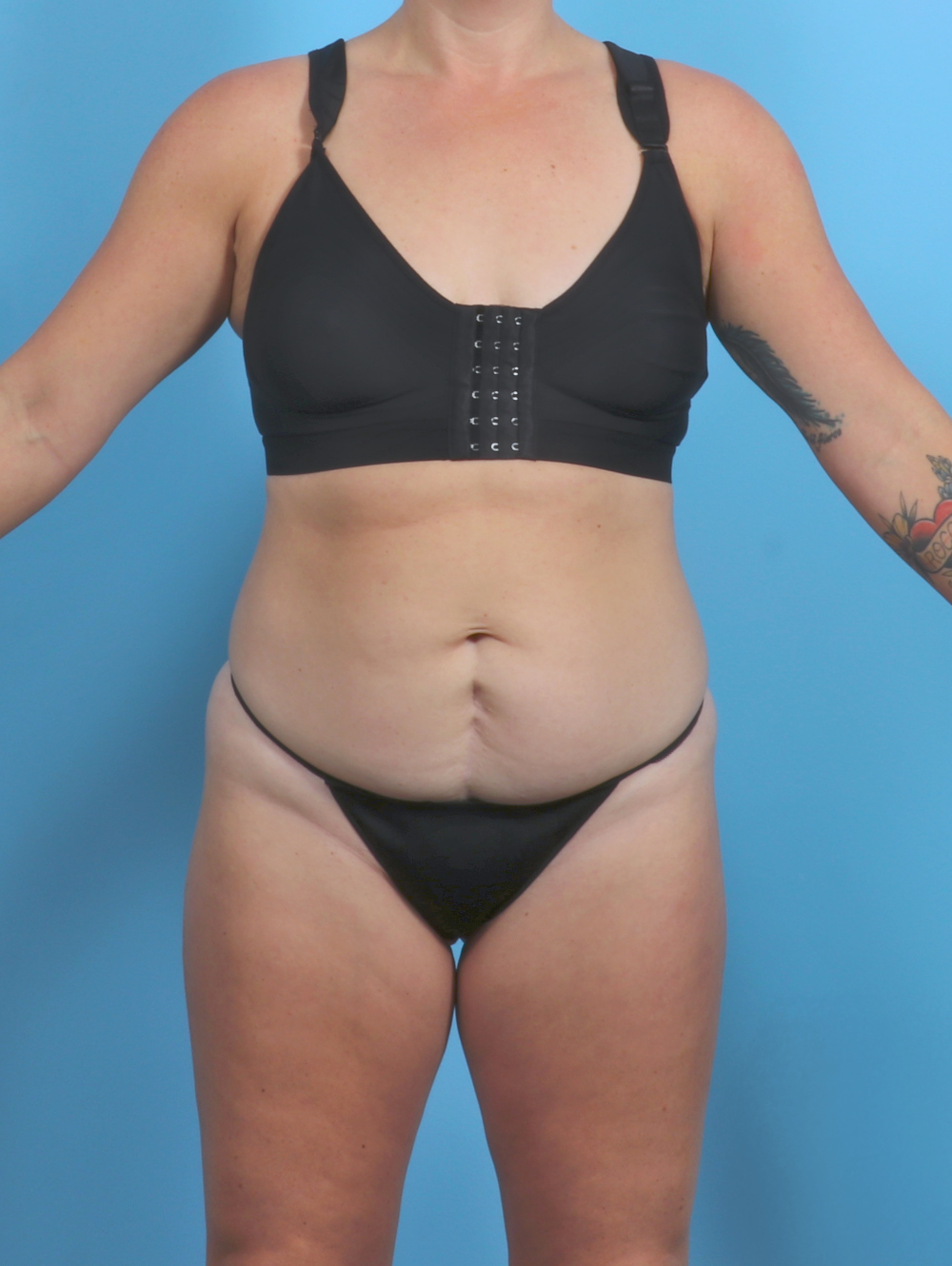 Tummy Tuck Patient Photo - Case 5813 - before view-0