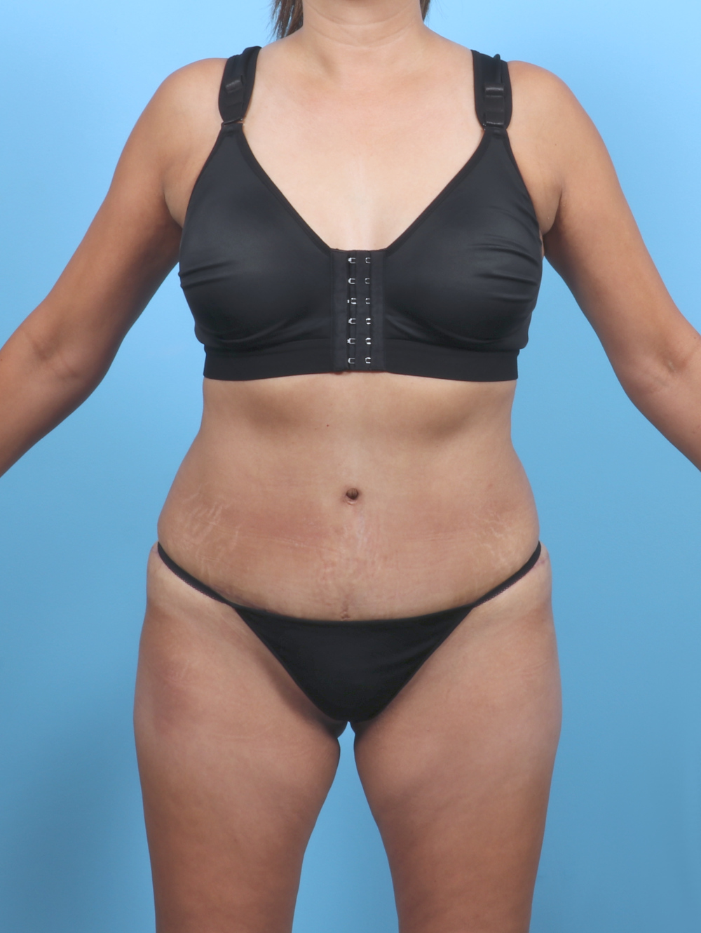 Tummy Tuck Patient Photo - Case 5839 - after view