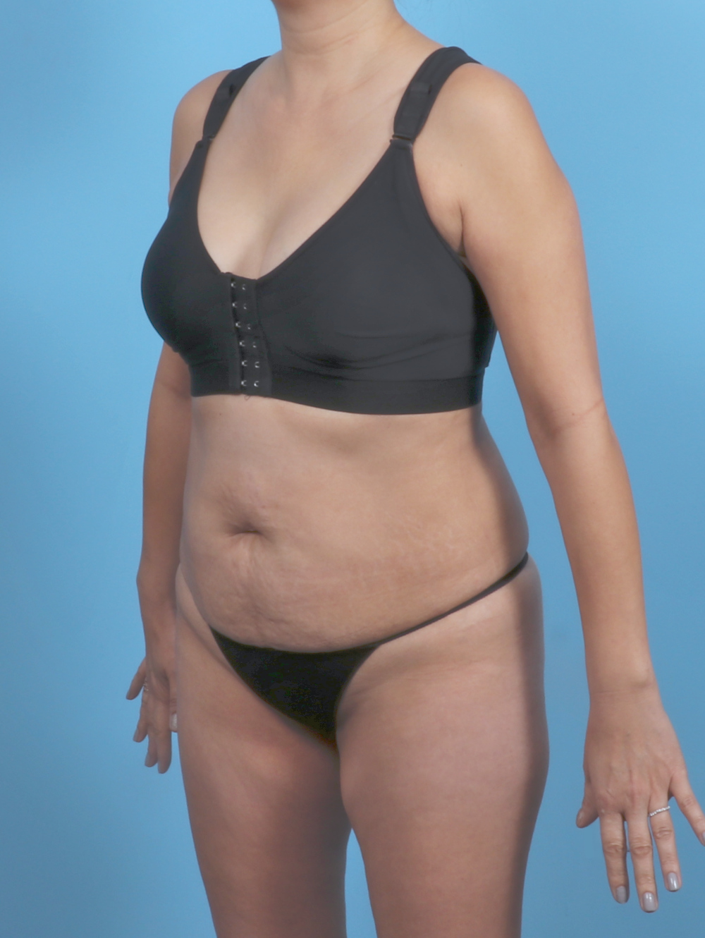 Tummy Tuck Patient Photo - Case 5839 - before view-1