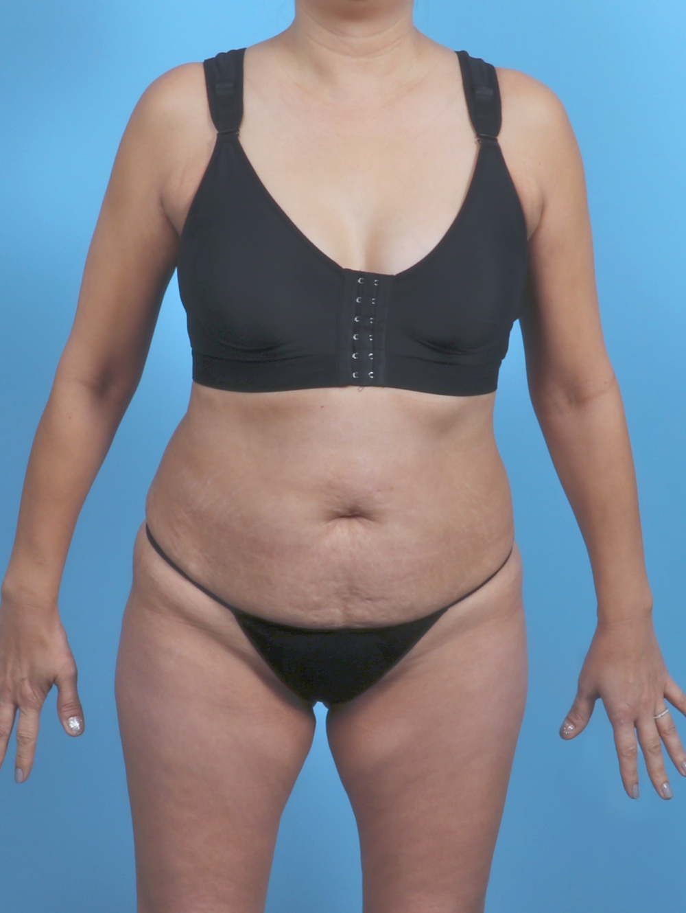 Tummy Tuck Patient Photo - Case 5839 - before view-0