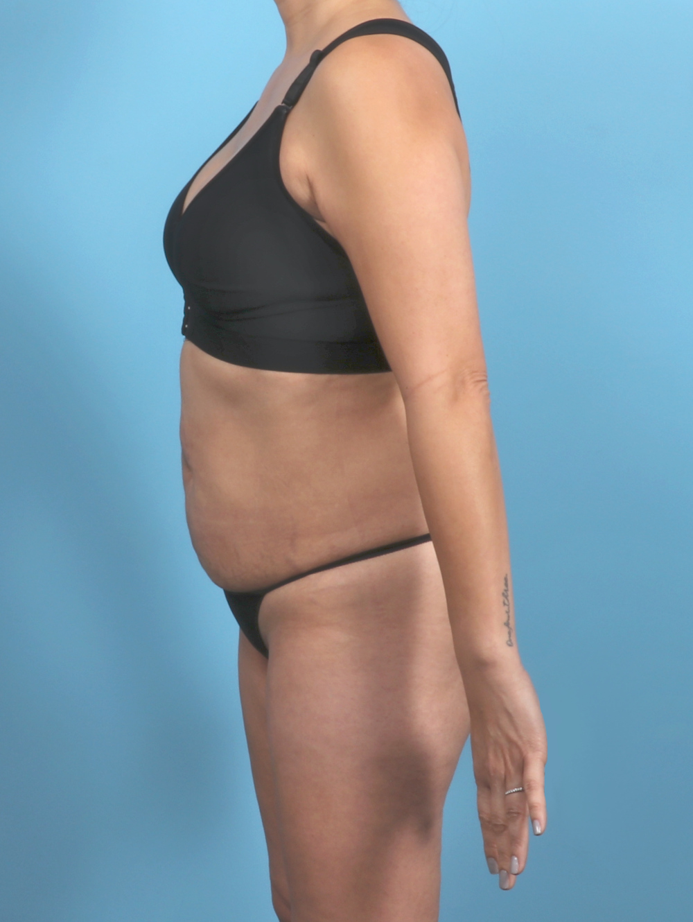 Tummy Tuck Patient Photo - Case 5839 - before view-2