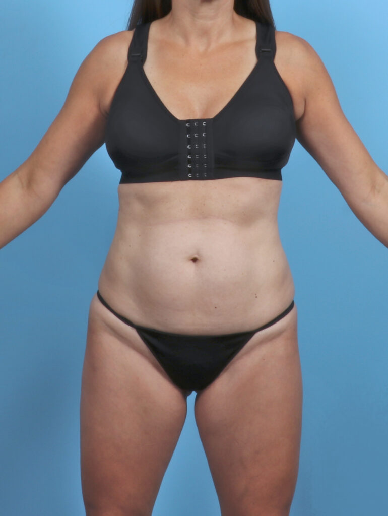 Liposuction - Case 5857 - Before