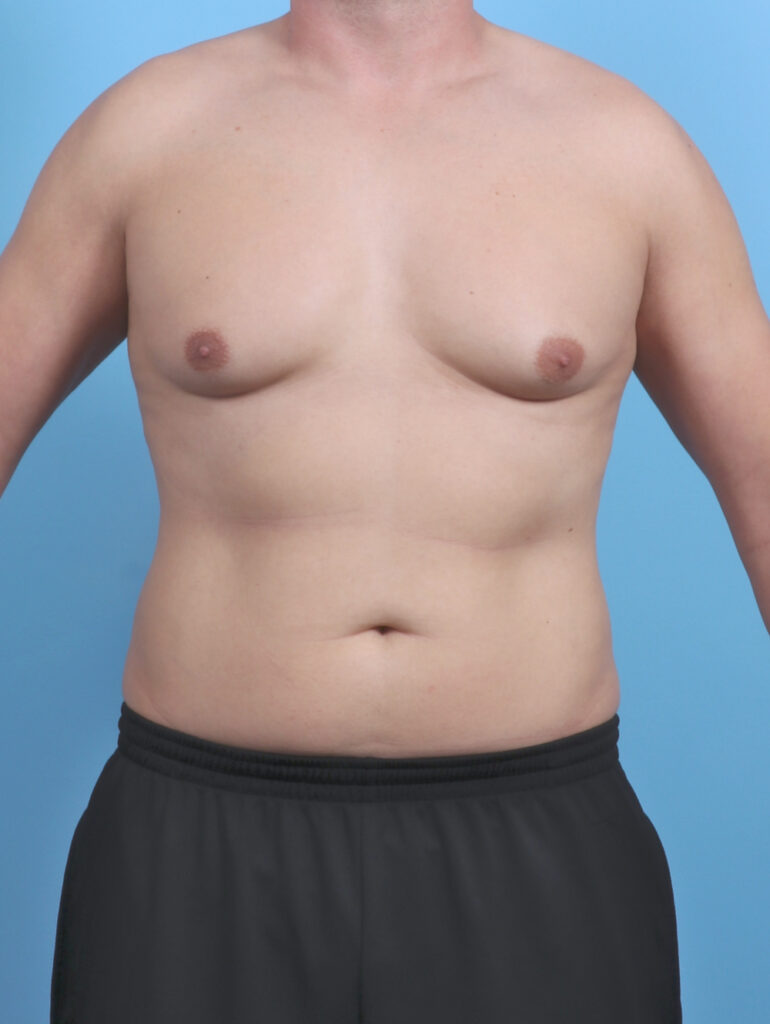 Male Breast Reduction - Case 5873 - Before
