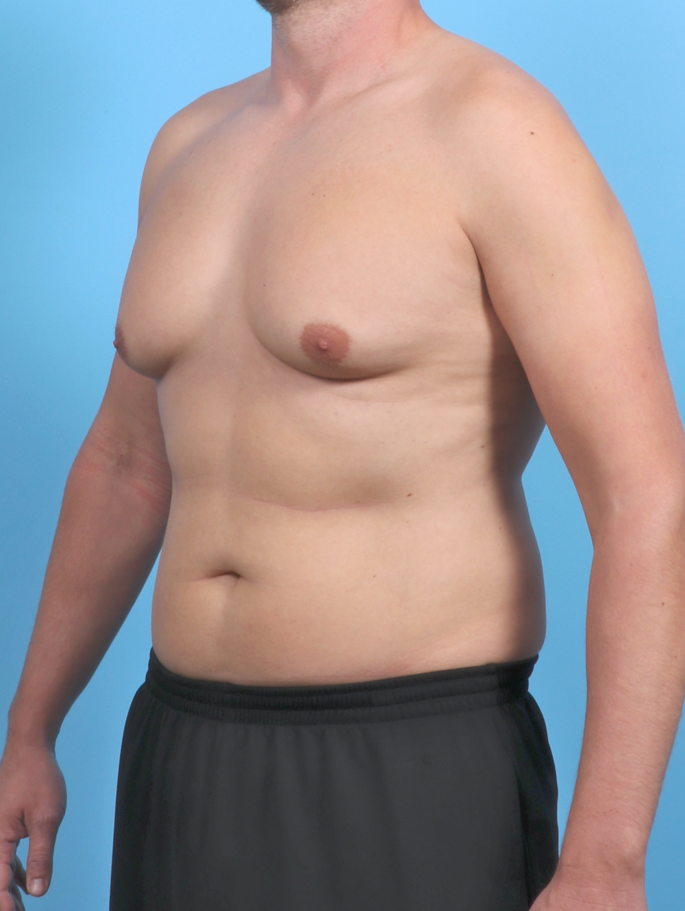Male Breast Reduction Patient Photo - Case 5873 - before view-1