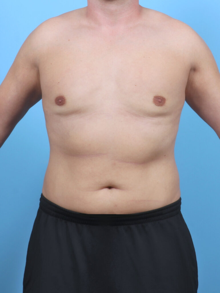 Male Breast Reduction - Case 5873 - After