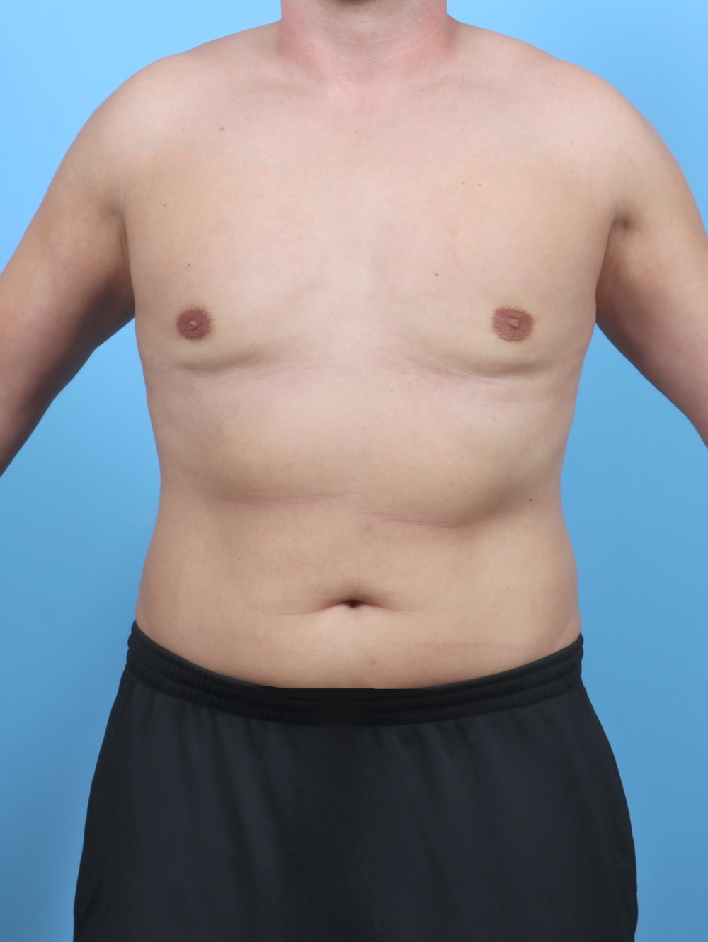 Male Breast Reduction Patient Photo - Case 5873 - after view