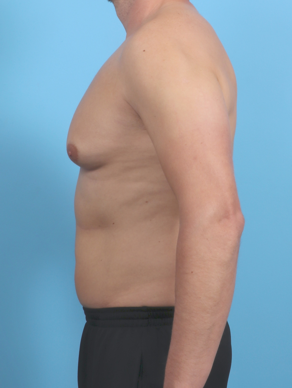 Male Breast Reduction Patient Photo - Case 5873 - before view-2