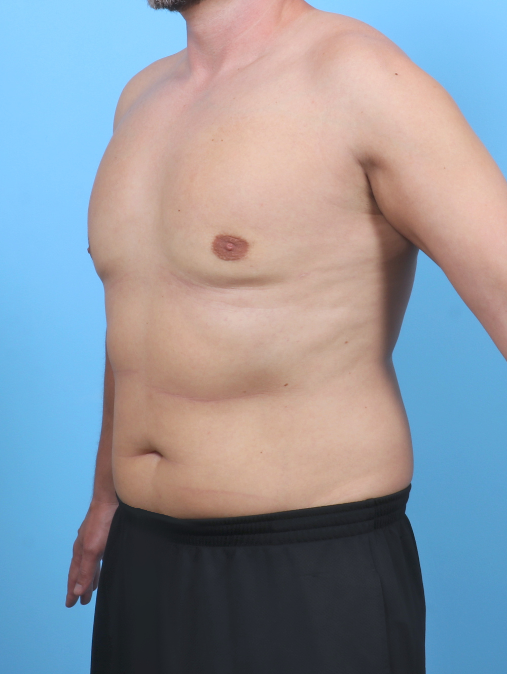 Male Breast Reduction Patient Photo - Case 5873 - after view-1