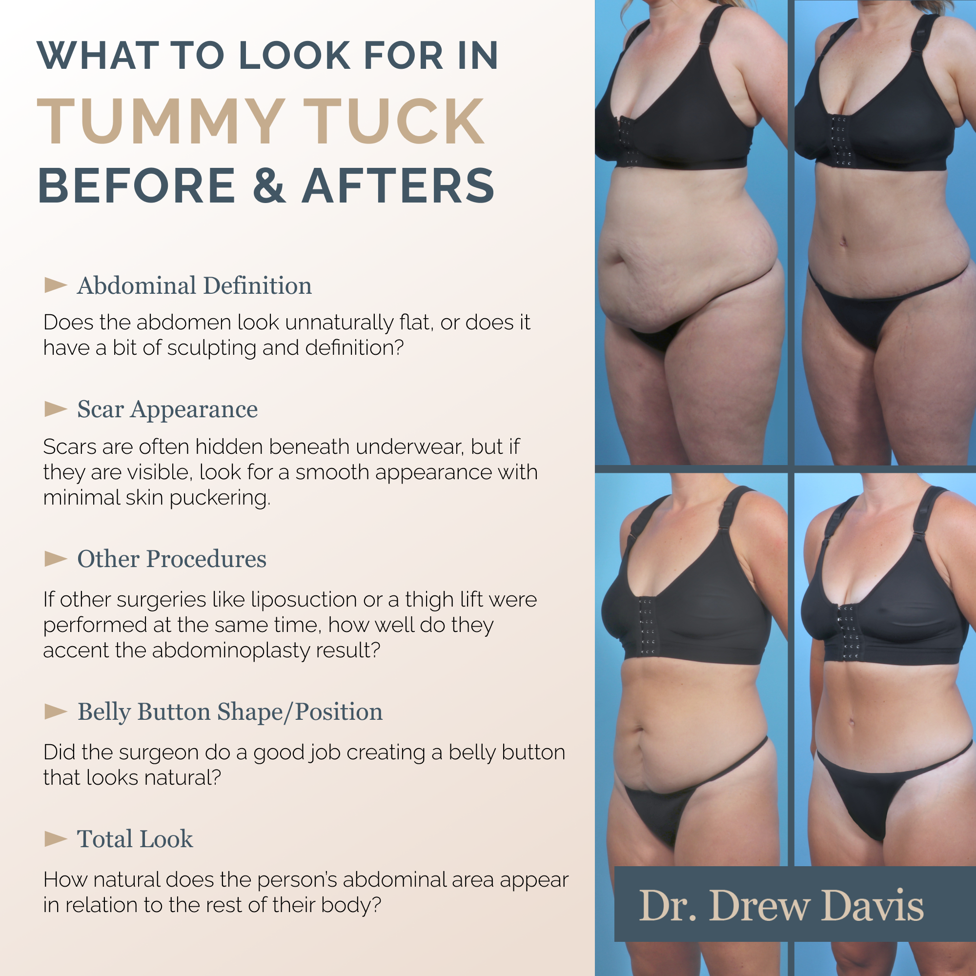 What to Look for in Tummy Tuck Before & Afters