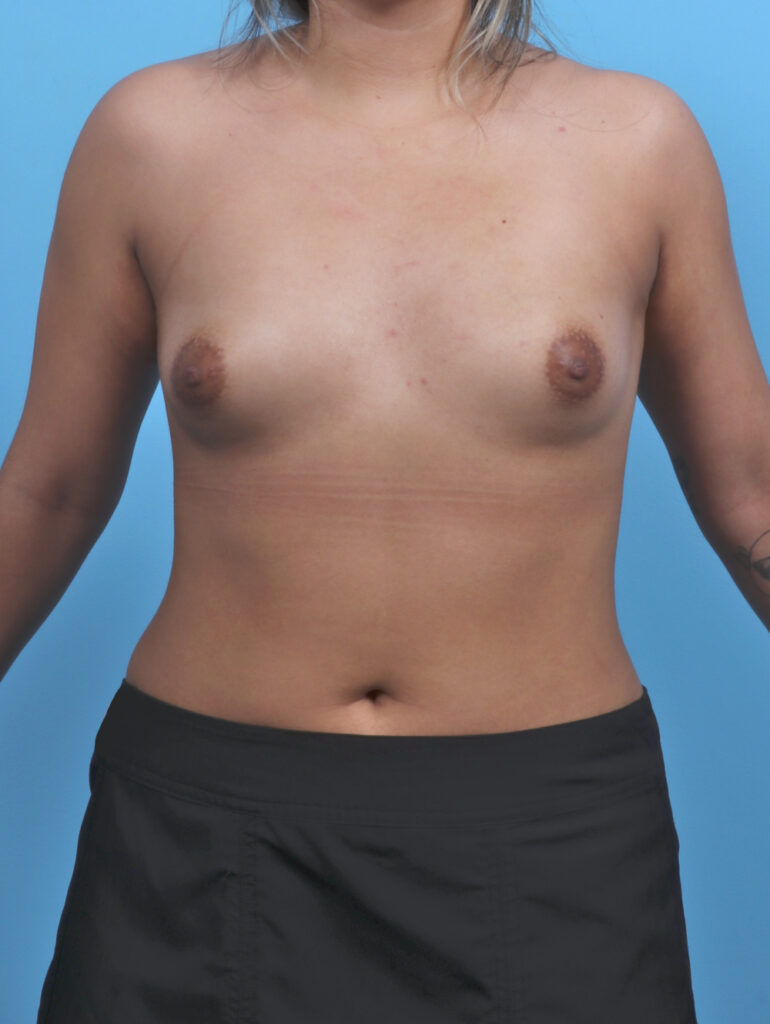 Breast Augmentation - Case 5968 - Before